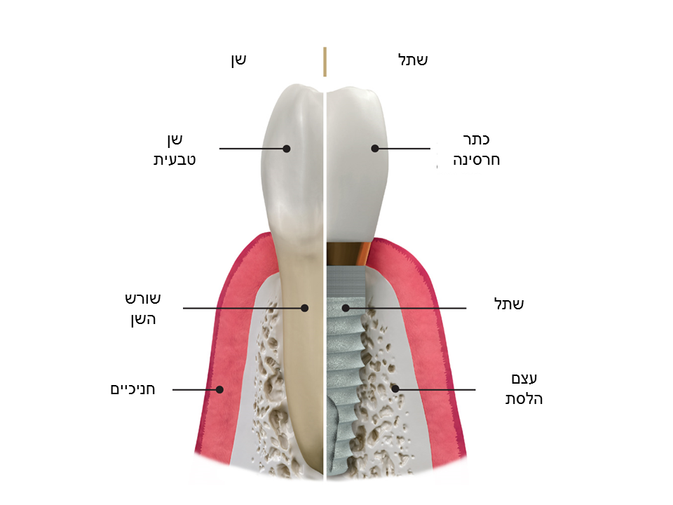 השתלת שיניים בכפר סבא