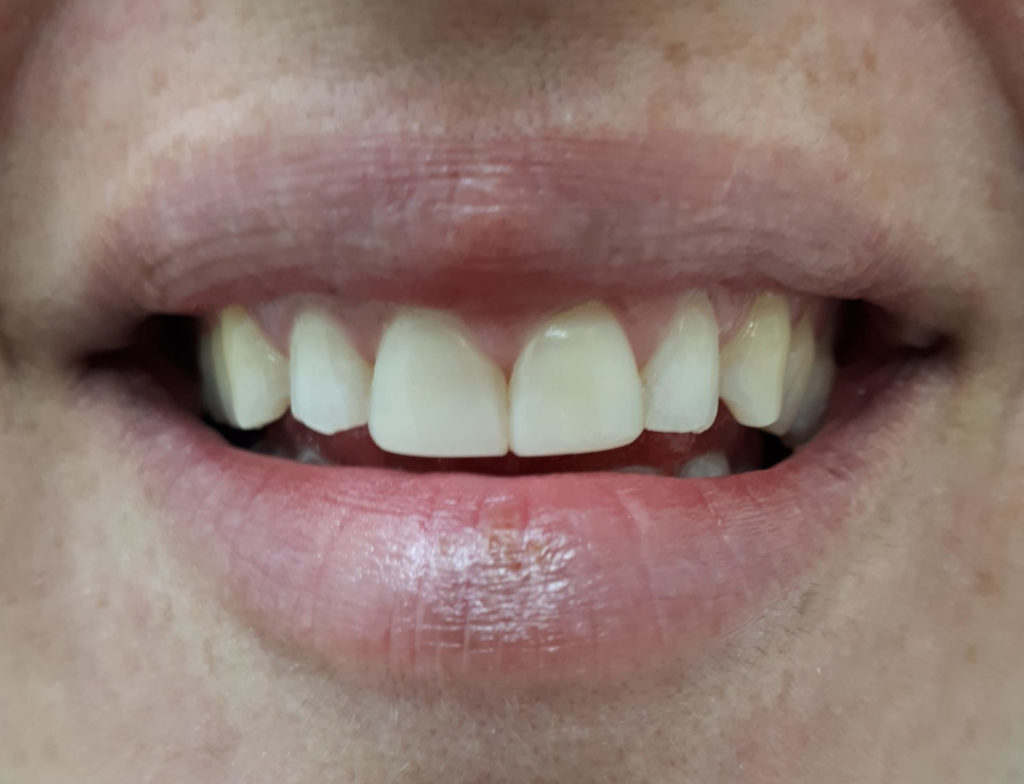 אחרי הטיפול