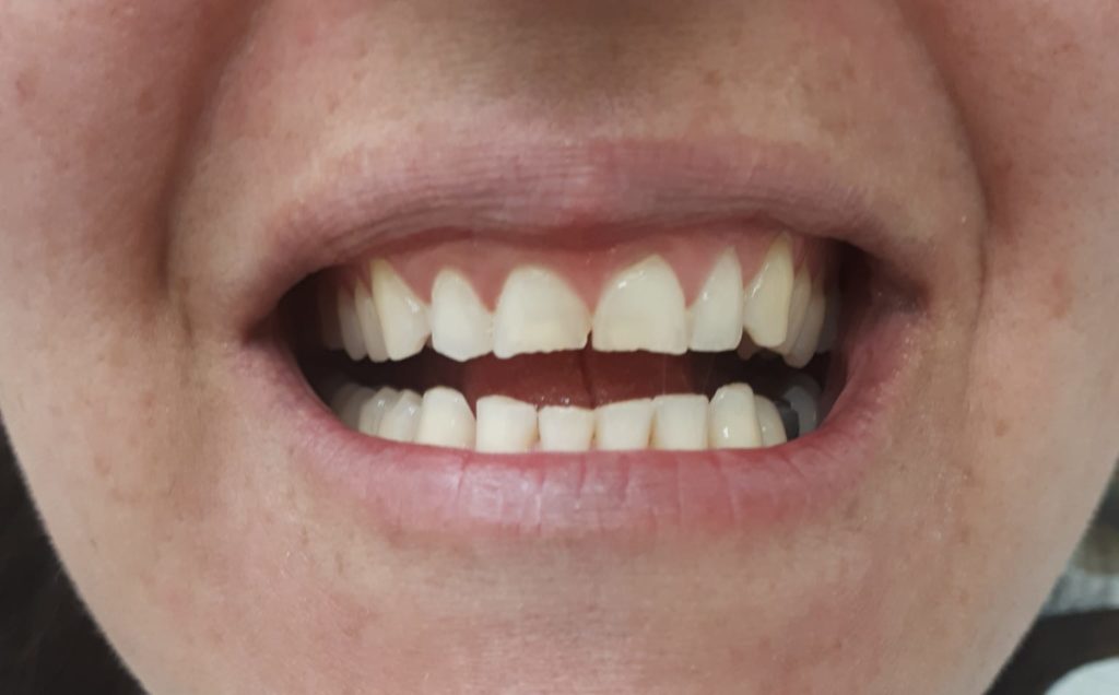 לפני הטיפול