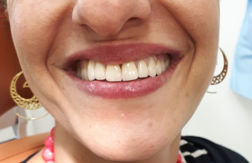 אחרי הטיפול כתרי חרסינה על זירקוניה