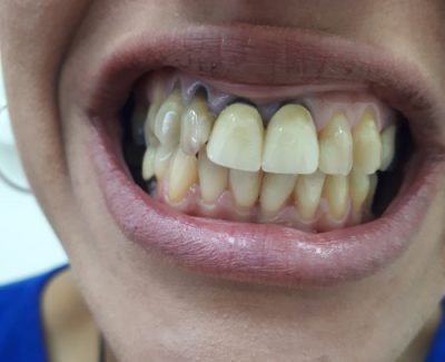 מצב לפני הטיפול