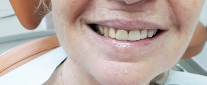 אחרי: כתרים חדשים חרסינה על זירקוניה