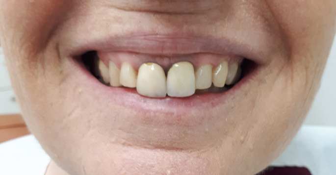 לפני: כתרים קדמיים לא מתאימים בצבע ובצורה