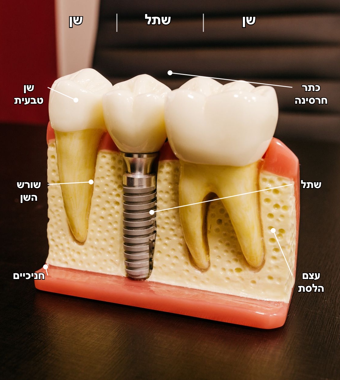 Implant cross-section model; the original diagram's six Hebrew labels reproduced unchanged השתלת שיניים בכפר סבא